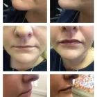 Business 14 image ANGEL AESTHETICS BY RACHEL Skin Care Clinics in ST HELENS Me