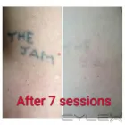 Business 7 image THE MISSING INK: LASER TATTOO REMOVAL Tattoo Removal Service in Hazel Grove Gr